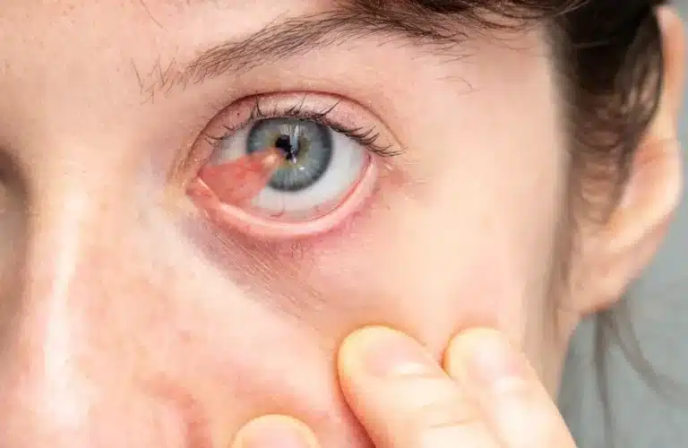 Eye with pterygium