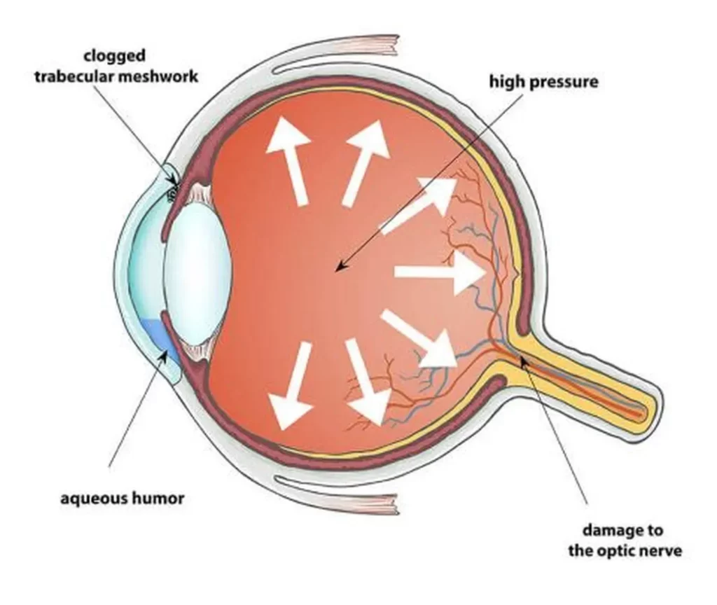 Open Angle Glaucoma Diagram